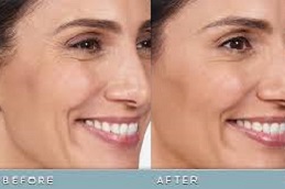 Best Botox Injection Clinic in Abu Dhabi