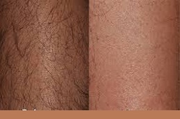 Best Laser Hair Removal Clinic in Abu Dhabi