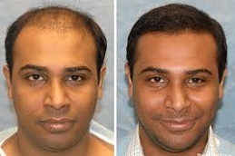 Cost of Hair Transplant in Abu Dhabi & Al Ain