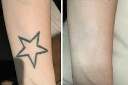 Laser Tatto Removal in Abu Dhabi