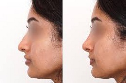 Non Surgical Nose Job Clinic in Abu Dhabi