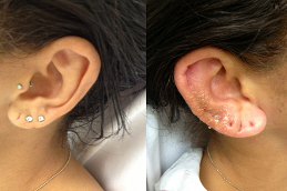 Best Ear Piercing Clinic in Abu Dhabi & Al Ain