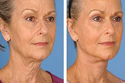 Best Non-Surgical Facelift in Abu Dhabi & Al Ain - Copy