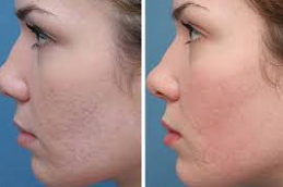 Best Subscision Treatment for Acne Scars in Abu Dhabi