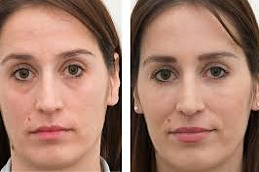 Non-Surgical Facelift Clinic in Abu Dhabi