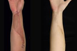 Post-Surgical Scars Treatment Clinic in Abu Dhabi