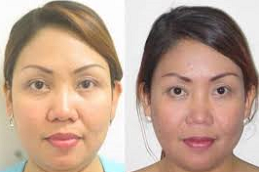 Subscision Treatment for Acne Scars in Abu Dhabi