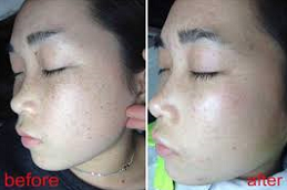 best Large Pores Treatment in Abu Dhabi