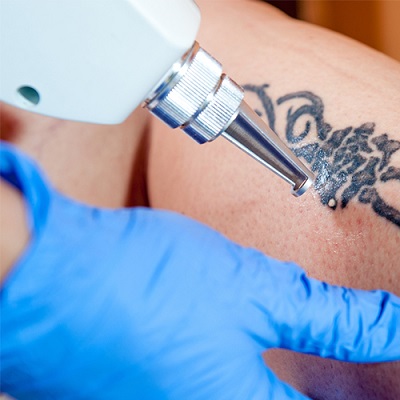 Best Laser Tattoo Removal in Abu Dhabi khalifa City Cost & Price