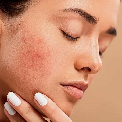 Best Acne Treatment in Abu Dhabi & Al Ain Acne Facial Cost UAE