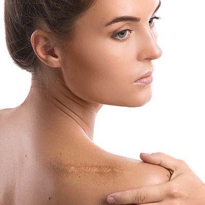 Best Surgical Scar Revision in Abu Dhabi & Al Ain Cost & Price