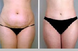 Best Clinic for Stretch Marks Removal Clinic in Abu Dhabi