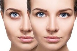 Best Clinic for Under Eye Fillers in Abu Dhabi