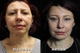Best Facelift Clinic in Abu Dhabi