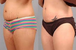 Clinic for Stretch Marks Removal in Abu Dhabi