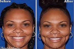 Dimple Creation Surgery in Abu Dhabi