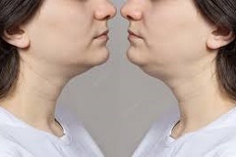 Double Chin Removal Clinic oin Abu Dhabi