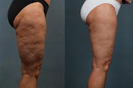 Best Cellulite Removal Treatment Clinic in Abu Dhabi