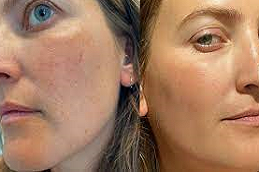 Best Facial Capillaries Treatment in Abu Dhabi