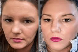 Best Fine Lines and Wrinkles Removal in Abu Dhabi & Al Ain