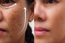Best Freckles & Blemishes Clinic in Abu Dhabi & Al Ain