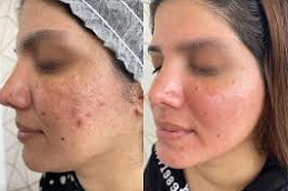Best Freckles & Blemishes in Abu Dhabi & Al Ain Clinic - Copy