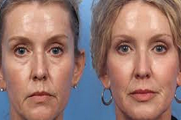 Best Non-Surgical Facelift in Abu Dhabi - Copy