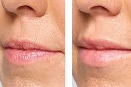 Best Somkers Lips Treatment in Abu Dhabi