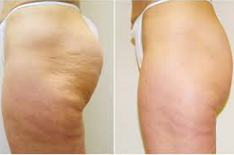 Cellulite Removal Treatment in Abu Dhabi