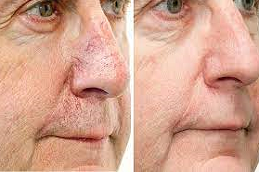 Facial Capillaries Treatment in Abu Dhabi & Al Ain