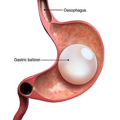 Gastric Balloon Placement in Abu Dhabi & Al Ain Weight Loss