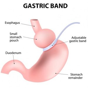 Gastric Banding in Abu Dhabi & Al Ain lap band surgery