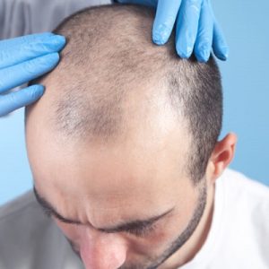 Hair Transplant for Genetic Hair loss in Abu Dhabi & Al Ain