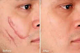 Hypertrophic scar removal Clinic in Abu Dhabi