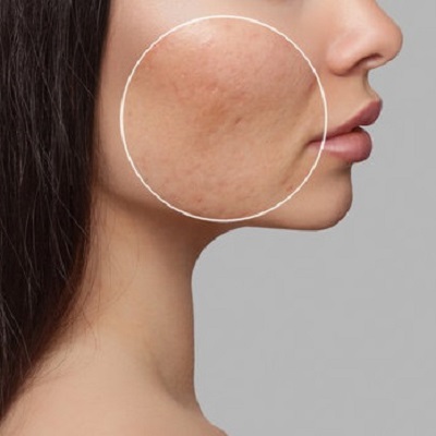 Large Pores Treatment 3 Proven Ways in Abu Dhabi