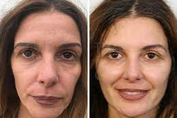 Non-Surgical Facelift in Abu Dhabi