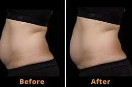 SculpSure Body Contouring in Abu Dhabi