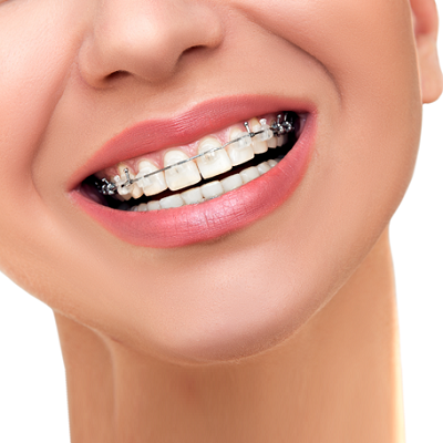 Protruding Teeth Treatment In Abu Dhabi & Al Ain Protruded Cost