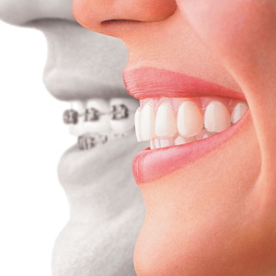 Teeth Straightening & Alignment in Abu Dhabi & Al Ain Cost & Price