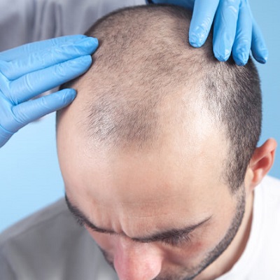 What is The Right Time For a Hair Transplant?