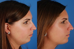 Before After Chin liposuction in Abu Dhabi