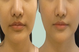 Before & After Lip Reduction Surgery in Abu Dhabi & Al Ain