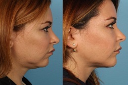 Chin Liposuction in Abu Dhabi Before & After