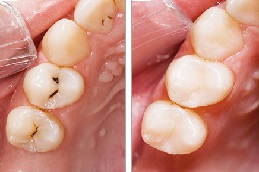Dental Tooth Filling in Abu Dhabi & Al Ain