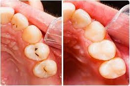 Dental Tooth Filling