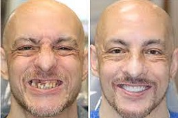Tooth Removal in Abu Dhabi